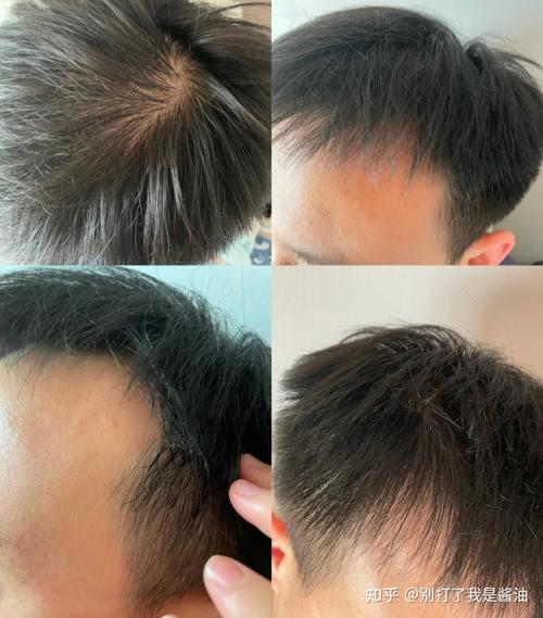 香港今晚开奖结果开奖记录和因发量太多剃掉头发与因发量太多剃掉头发会怎么样